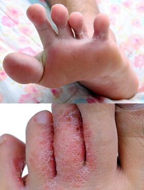 Foot mushroom