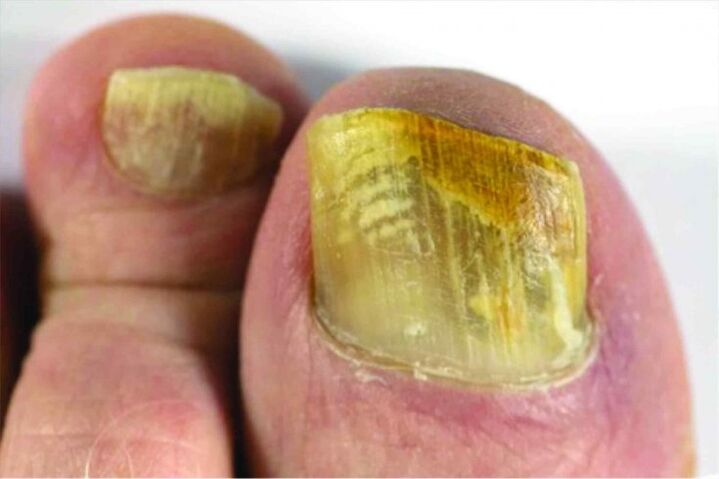 A feeling of nail on your leg