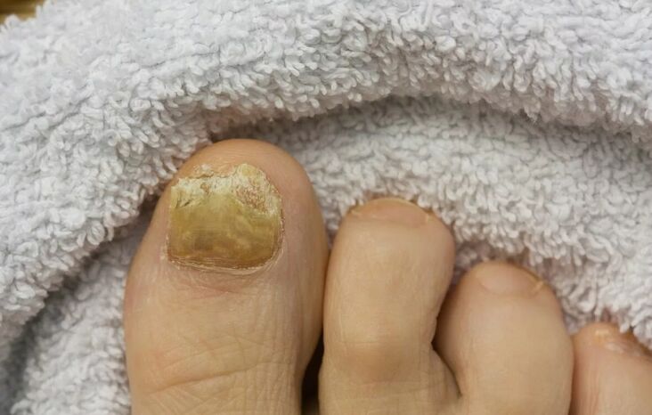 Fungus nail