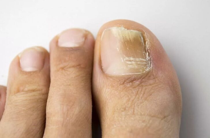 Mycosis nail on your leg